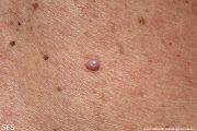 myxoma-cutaneous_myxoma
