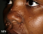 trichoepithelioma