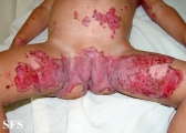 acrodermatitis enteropathica