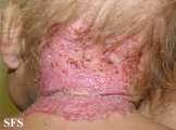 acrodermatitis enteropathica