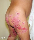 acrodermatitis enteropathica