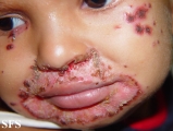 acrodermatitis enteropathica