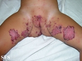 acrodermatitis enteropathica
