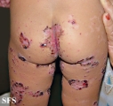 acrodermatitis enteropathica