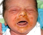 acrodermatitis enteropathica