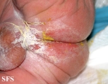 acrodermatitis enteropathica
