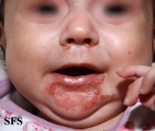 acrodermatitis enteropathica