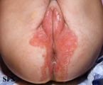 acrodermatitis enteropathica