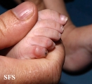 acrodermatitis enteropathica