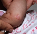 acrodermatitis enteropathica