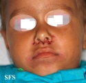 acrodermatitis enteropathica