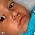 acrodermatitis enteropathica