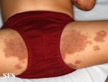 acrodermatitis enteropathica