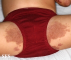 acrodermatitis enteropathica