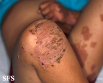acrodermatitis enteropathica