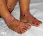 acrodermatitis enteropathica