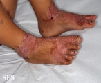 acrodermatitis enteropathica