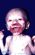 acrodermatitis enteropathica