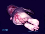 acrodermatitis enteropathica
