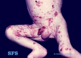 acrodermatitis enteropathica