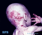 acrodermatitis enteropathica