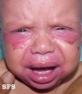 acrodermatitis enteropathica
