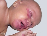 acrodermatitis enteropathica