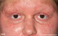 acrodermatitis enteropathica