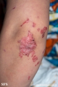 acrodermatitis enteropathica
