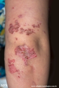 acrodermatitis enteropathica