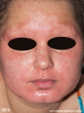 acrodermatitis enteropathica