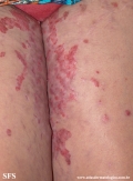 acrodermatitis enteropathica
