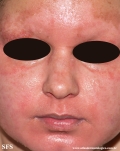acrodermatitis enteropathica