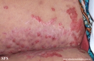 acrodermatitis enteropathica