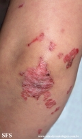 acrodermatitis enteropathica