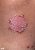 acrodermatitis enteropathica