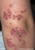 acrodermatitis enteropathica