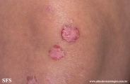 acrodermatitis enteropathica