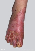 acrodermatitis enteropathica