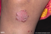 acrodermatitis enteropathica