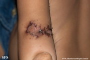 acrodermatitis enteropathica