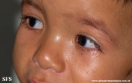 acrodermatitis enteropathica