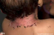 acrodermatitis enteropathica