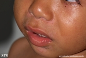 acrodermatitis enteropathica
