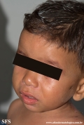 acrodermatitis enteropathica