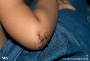 acrodermatitis enteropathica