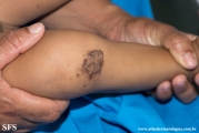 acrodermatitis enteropathica