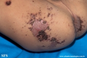 acrodermatitis enteropathica