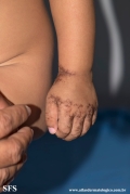acrodermatitis enteropathica