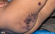 acrodermatitis enteropathica